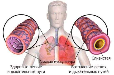 отек легких и пневмония это одно и тоже