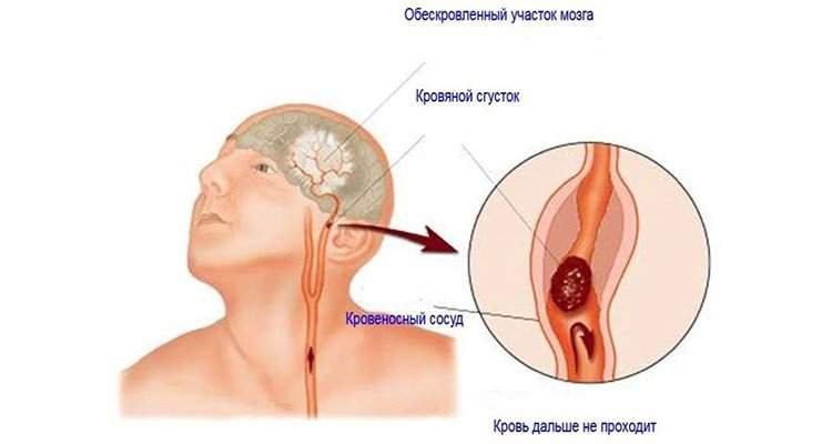 отек мозга инфаркт мозга вызванный тромбозом мозговых артерий