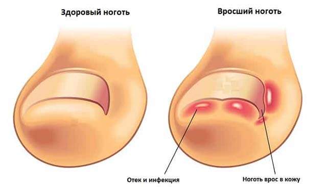 отек палец на ноге без причины и болит