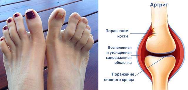Болит большой палец на ноге чем лечить. Сустав большого пальца ноги. Воспаление сустава стопы. Артрит большого пальца ноги.