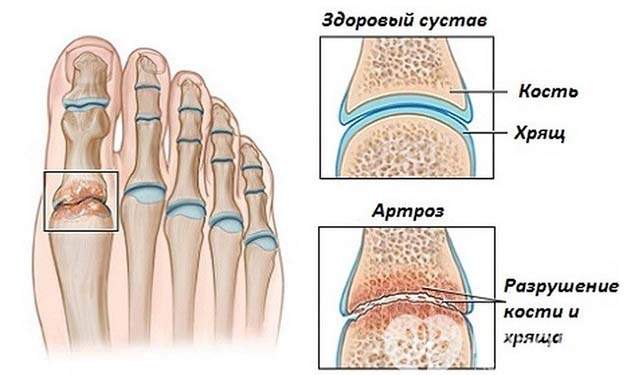 отек палец на ноге без причины и болит