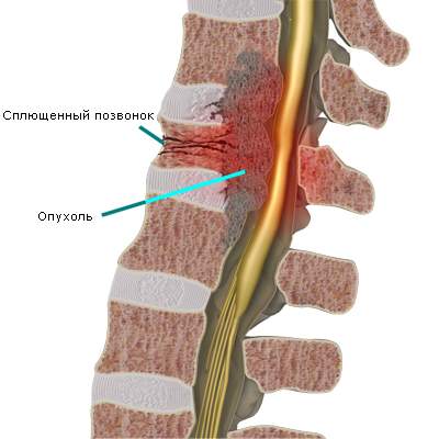отек периневральных пространств межпозвонковых отверстий с обеих сторон