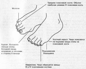 отек подушечки под большим пальцем ноги чем снять боль