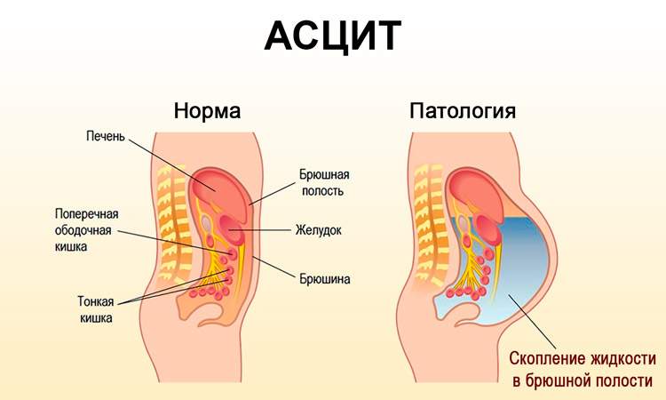 отеки нижних конечностей асцит увеличение печени признаки чего