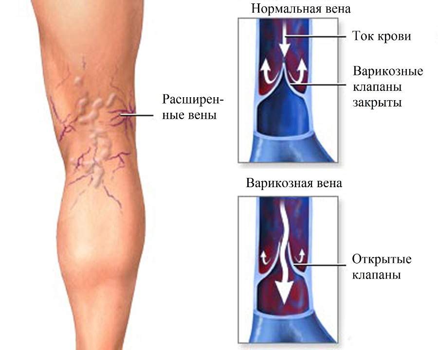 отеки ног при варикозе эффективное лечение народными средствами