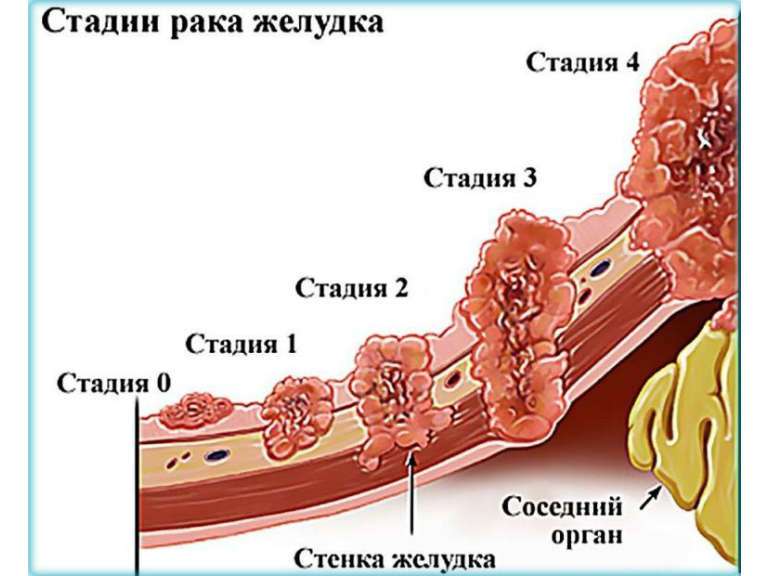 отеки при раке желудка 4 степени с метастазами