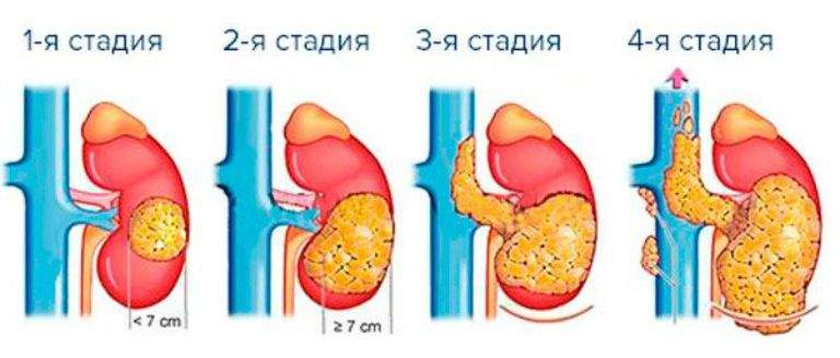 отеки при раке желудка 4 степени с метастазами