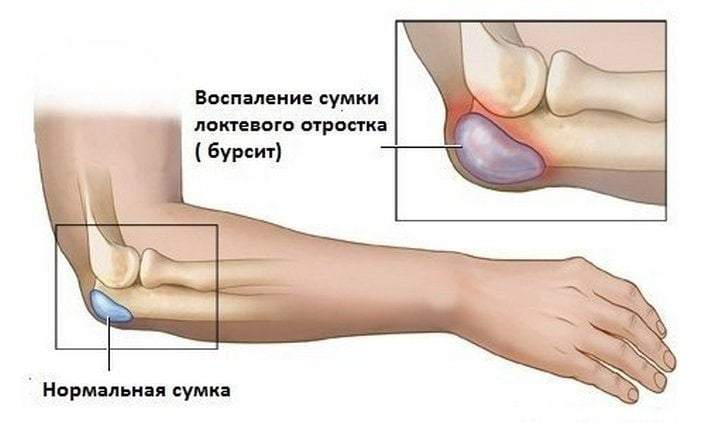 отекла одна рука от локтя до кисти причины