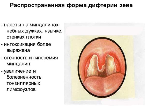 отекла шея с правой стороны и больно глотать