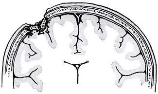 открытая черепно мозговая травма ушиб головного мозга