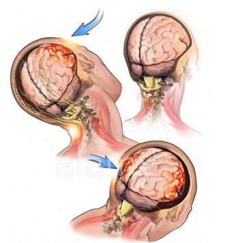 открытая черепно мозговая травма ушиб головного мозга