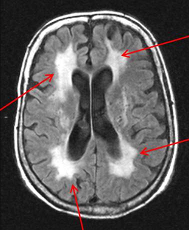 перивентрикулярно зоны отека и лейкоареоза шириной 2 мм