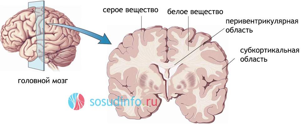 перивентрикулярно зоны отека и лейкоареоза шириной 2 мм