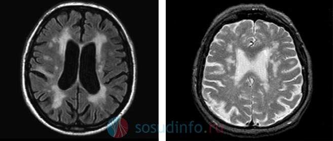 Мр картина перивентрикулярной лейкопатии