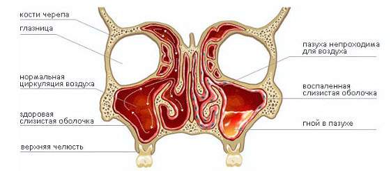 почему отек переходит из одной ноздри в другую