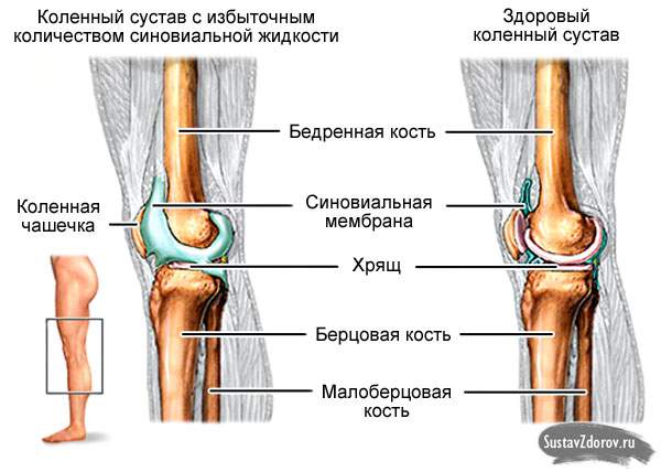 после ушиба колена собралась подкожная жидкость