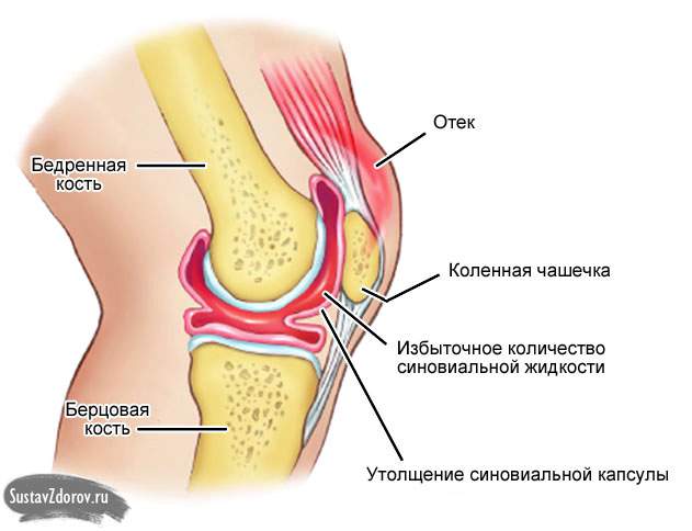 после ушиба колена собралась подкожная жидкость