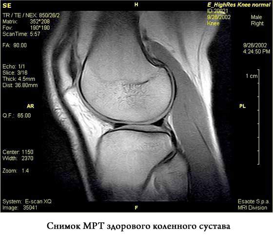 после ушиба колена собралась подкожная жидкость