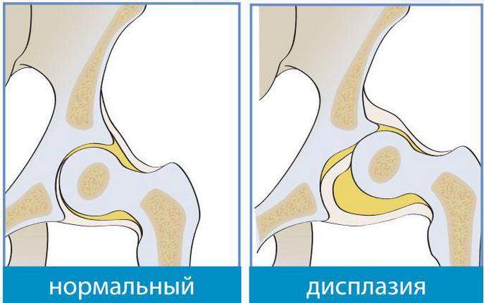 при врожденном вывихе бедра применяется пеленание