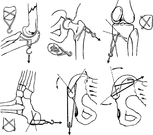 Схема скелетного вытяжения при переломах бедренной кости