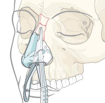Можно вправить нос. Перелом костей носа репозиция. Вправление перелома костей носа. Репозиция костей носа инструменты. Инструментальная репозиция костей носа.