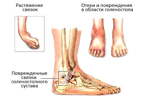 растяжение связок на голеностопном суставе месяц не проходит отек