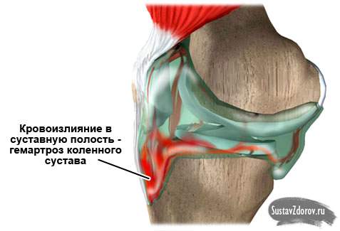 скопление крови в коленном суставе после ушиба