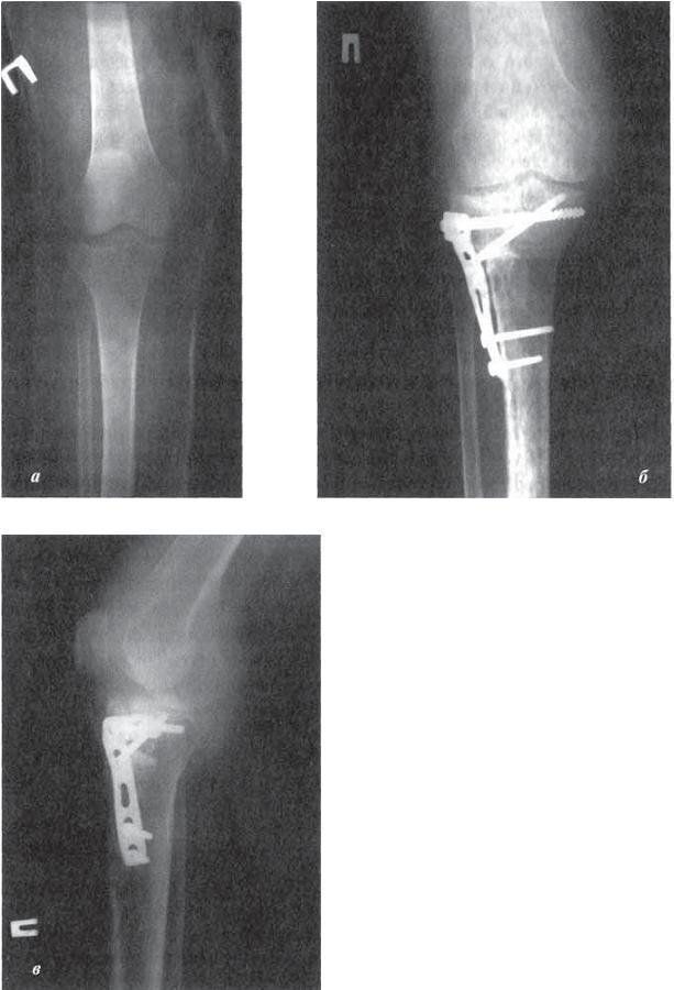 сроки иммобилизации при изолированном переломе большеберцовой кости