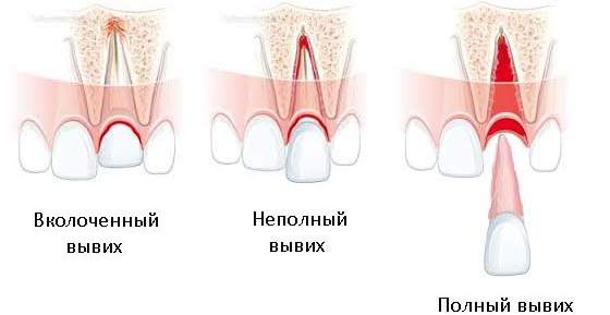 тактика врача при неполном вывихе временного зуба со смещением