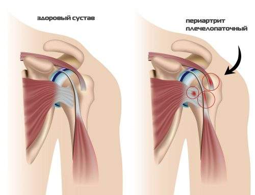 трабекулярный отек костного мозга большого бугорка плечевой кости