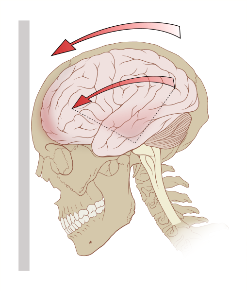 ушиб головного мозга средней степени тяжести лечение после стационара