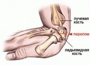 ушиб ладьевидной кости стопы симптомы и лечение