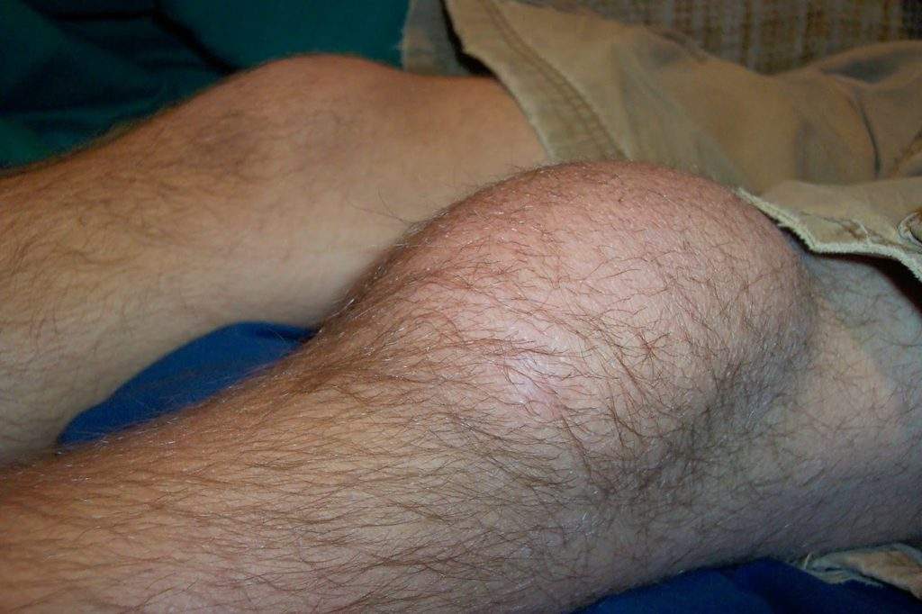 ушиб мениска коленного сустава лечение народными средствами