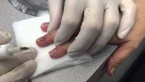 ушиб пальца кисти с повреждением ногтевой пластинки
