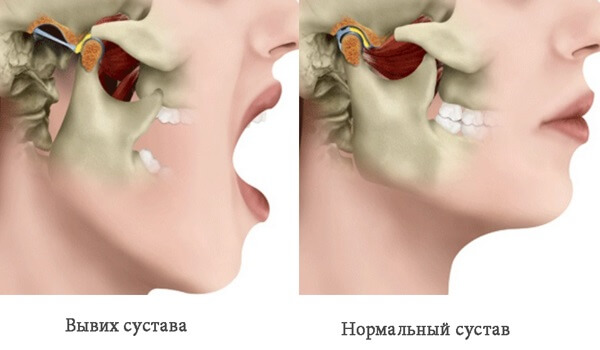 ведущий симптом при вывихе нижней челюсти
