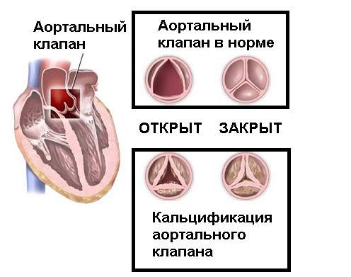 витамин к2 мк7 вызывает отеки ног и варикоз