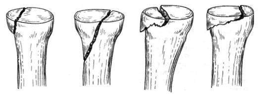 внутрисуставной перелом головки лучевой кости со смещением
