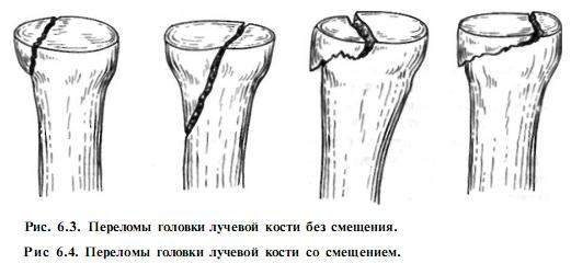 внутрисуставной перелом головки лучевой кости со смещением