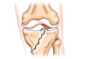внутрисуставной перелом коленного сустава как долго срастается