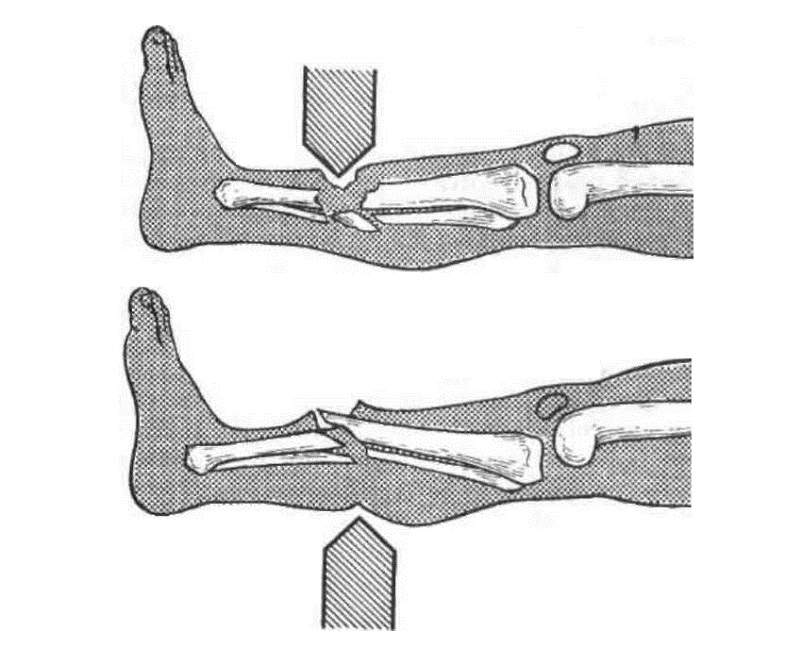 Открытый перелом кости руки. Первично открытые и вторично открытые переломы. Открытый перелом костные отломки. Дырчатые переломы переломы.