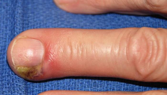 воспаление мягких тканей пальца руки после ушиба