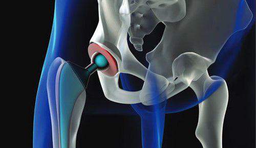 восстановление после операции при переломе шейки бедра