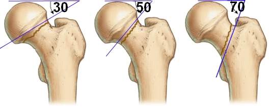закрытый базальный перелом шейки бедра без смещения
