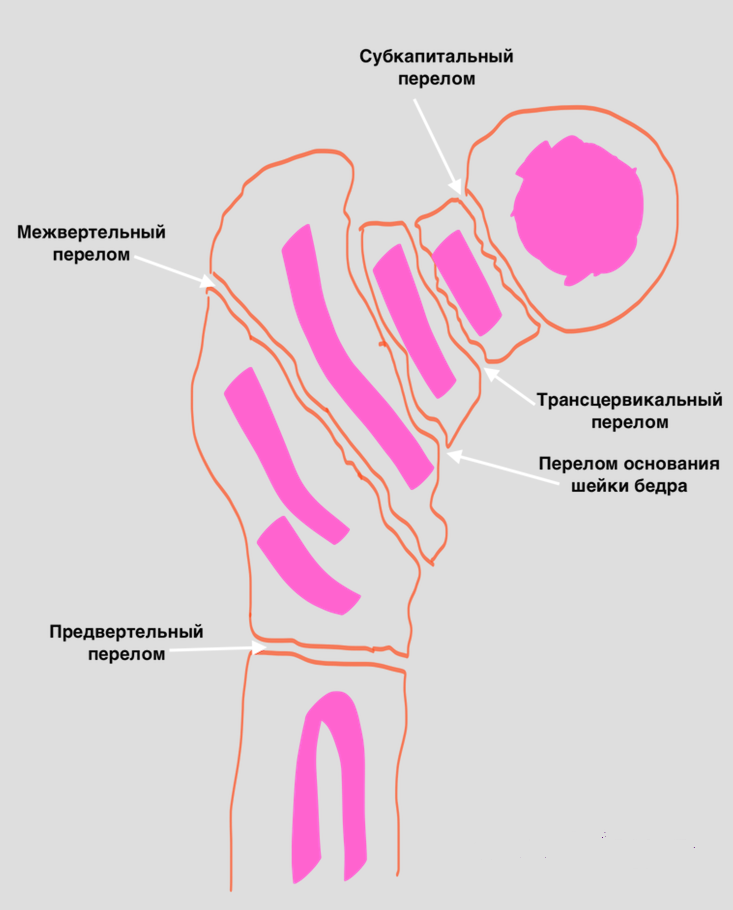 Субкапитальный перелом бедренной. Вколоченный перелом шейки бедра классификация. Субкапитальный перелом шейки бедренной кости. Классификация переломов шейки бедренной кости. Вколоченный перелом шейки бедра.