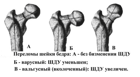 закрытый базальный перелом шейки бедра без смещения