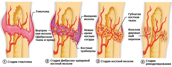 замедленное срастание и несрастание костей после переломов