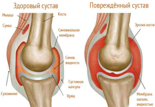 боль и отек в коленном суставе лечение