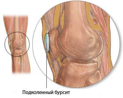 боль и отек в коленном суставе лечение