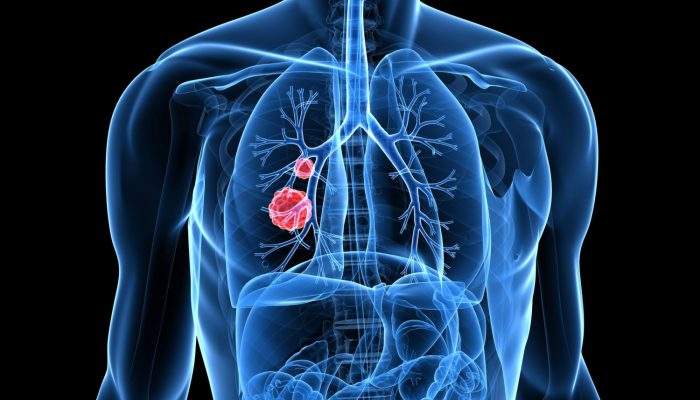 дифференциальная диагностика сердечной астмы и отека легких