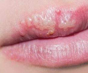 гиалуроновая кислота в губы сколько держится отек